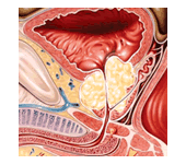 Доброкачественная гиперплазия предстательной железы(аденома простаты)
