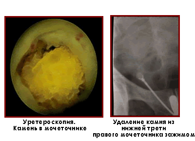 Уретероскопия. Камень в мочеточнике. Удаление камня из нижней трети правого мочеточника зажимом